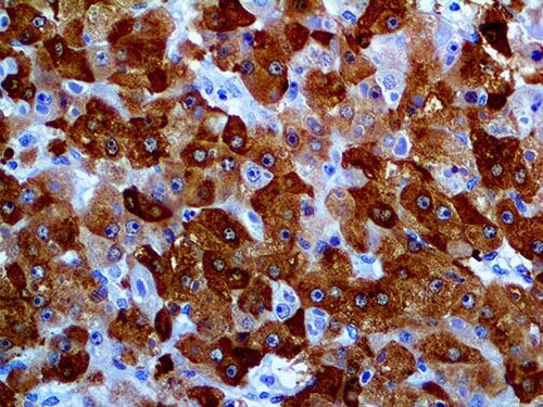 IHC of Glutamine Synthetase on an FFPE Hepatocellular Carcinoma Tissu